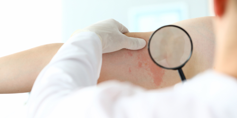 Вебинар «Академия Акне и Розацеа»